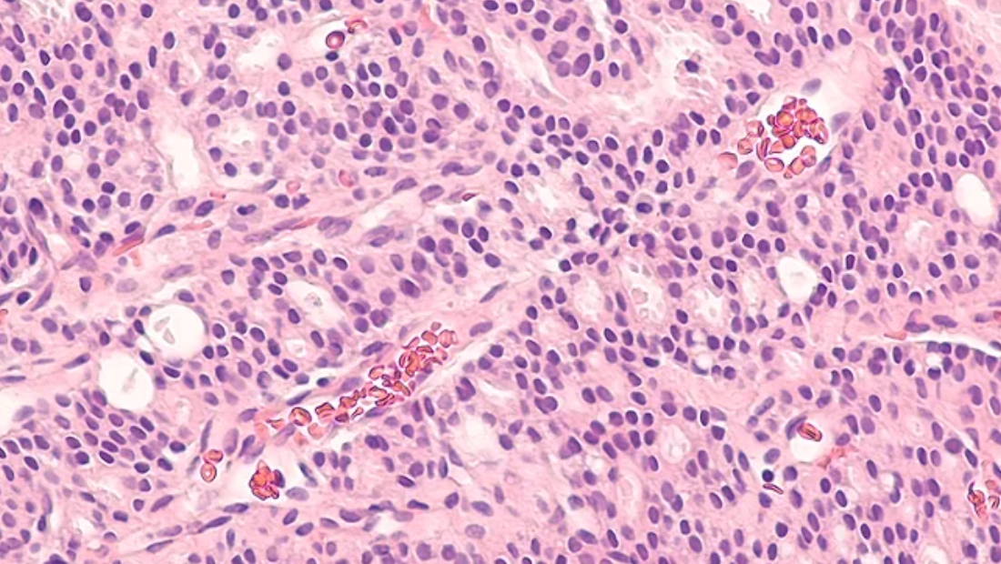 Advancing Hope for Prostate Cancer Patients: Johnson & Johnson Acquires Halda for $3.05B