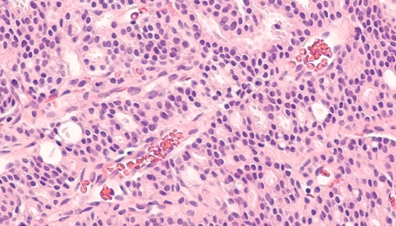 Advancing Hope for Prostate Cancer Patients: Johnson & Johnson Acquires Halda for $3.05B